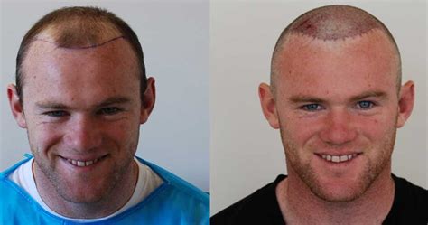 St. Louis, Missouri Hair Restoration .